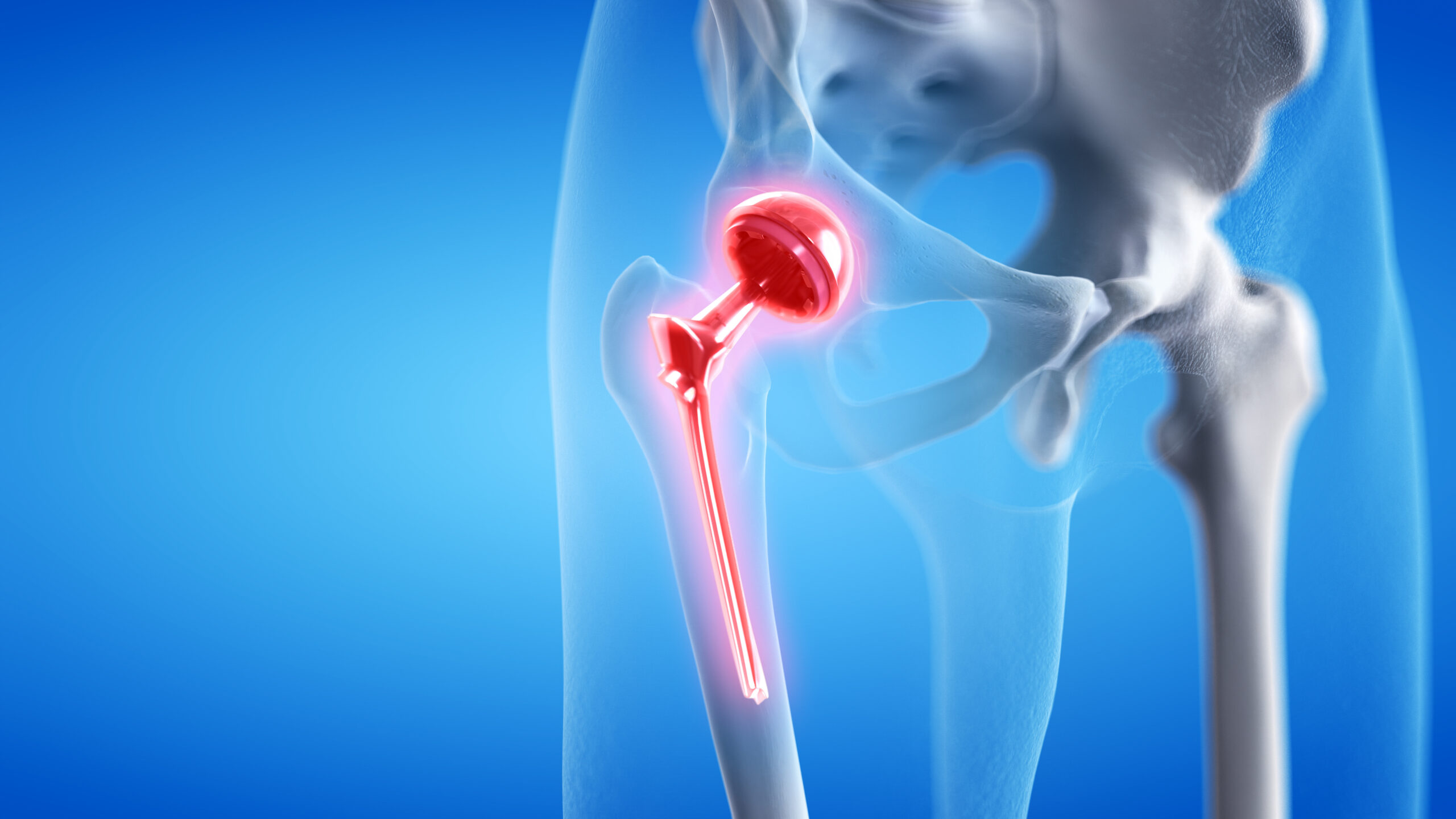 3d rendered medically accurate illustration of a painful hip replacement